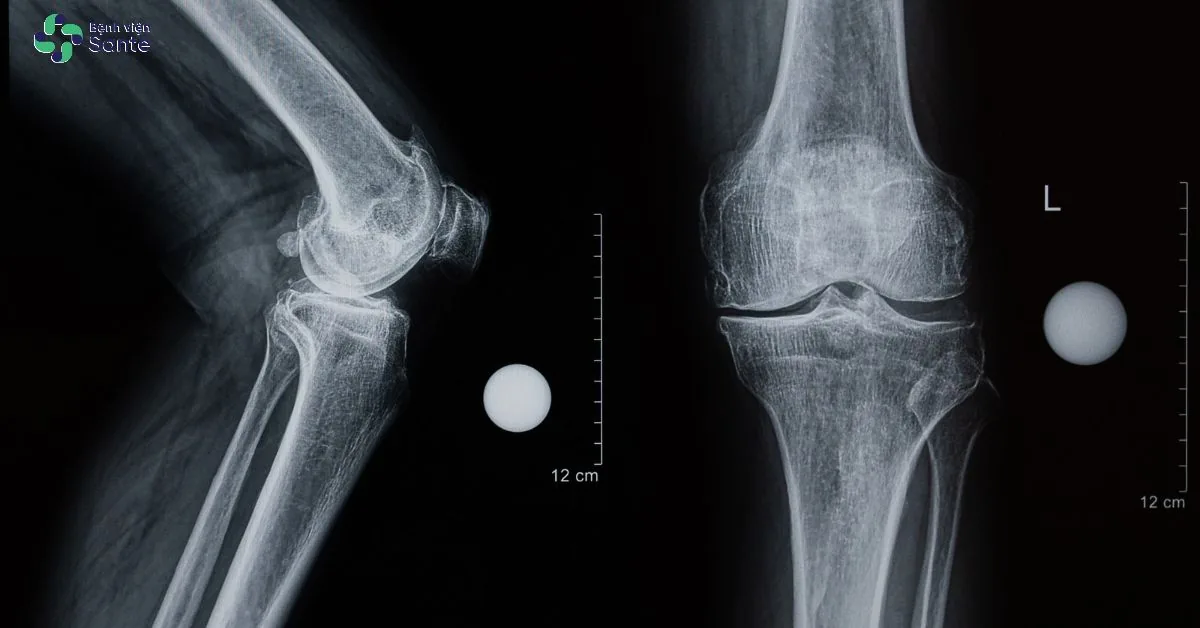 X-ray image of advanced knee osteoarthritis demonstrating severe joint space narrowing and prominent osteophytes