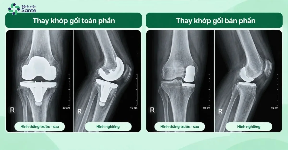 Phim X-quang so sánh thay khớp gối toàn phần và bán phần