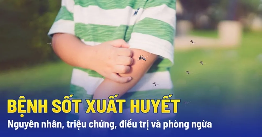 Những điều cần biết về sốt xuất huyết - Hình 2 - Bệnh viện SANTE Bình Thạnh, TP.HCM Những điều cần biết về sốt xuất huyết - Hình 2 - Bệnh viện SANTE Bình Thạnh, TP.HCM